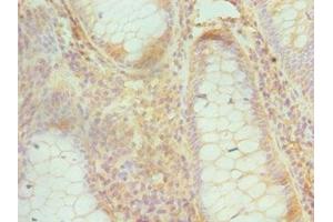 Immunohistochemistry of paraffin-embedded human colon cancer using ABIN7148748 at dilution of 1:100 (Cullin 1 anticorps  (AA 500-776))
