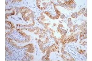 Immunohistochemistry (IHC) staining of Human Lung Cancer tissue, diluted at 1:200. (Cytokeratin 7 anticorps)