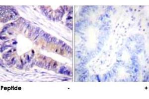 Immunohistochemical analysis of paraffin-embedded human colon carcinoma tissue using YWHAZ polyclonal antibody . (14-3-3 zeta anticorps)
