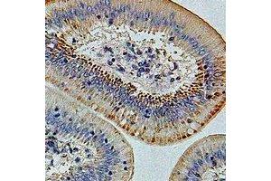 Immunohistochemical analysis of IFI44 staining in human colon cancer formalin fixed paraffin embedded tissue section.