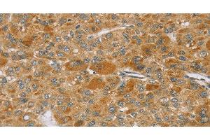 Immunohistochemistry of paraffin-embedded Human liver cancer using TP53I11 Polyclonal Antibody at dilution of 1:40 (TP53I11 anticorps)