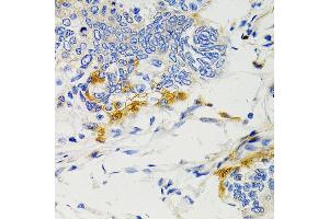 Immunohistochemistry of paraffin-embedded human gastric cancer using SHP2 antibody (ABIN3016706, ABIN3016707, ABIN3016708 and ABIN6219822) at dilution of 1:100 (40x lens).