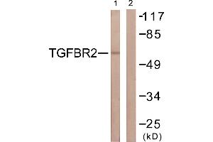 Immunohistochemistry analysis of paraffin-embedded human breast carcinoma tissue using CDC16/APC6 (Ab-560) antibody. (CDC16 anticorps  (Ser560))