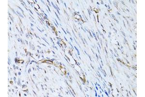 Immunohistochemistry of paraffin-embedded human uterine cancer using SELE Antibody. (Selectin E/CD62e anticorps)