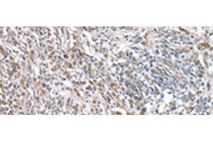 Immunohistochemistry of paraffin-embedded Human prost ate cancer tissue using RNF115 Polyclonal Antibody at dilution of 1:45(x200) (RNF115 anticorps)