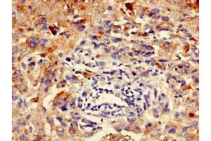 Immunohistochemistry of paraffin-embedded human melanoma using ABIN7151778 at dilution of 1:100 (ELMO3 anticorps  (AA 464-596))
