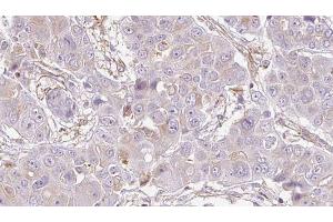 ABIN6272736 at 1/100 staining Human liver cancer tissue by IHC-P.