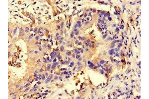 Immunohistochemistry of paraffin-embedded human bladder cancer using ABIN7160827 at dilution of 1:100