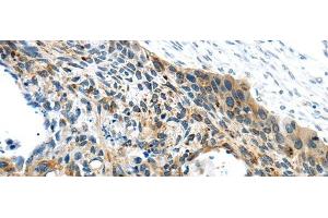 Immunohistochemistry of paraffin-embedded Human esophagus cancer using VAMP2 Polyclonal Antibody at dilution of 1/40 (VAMP2 anticorps)