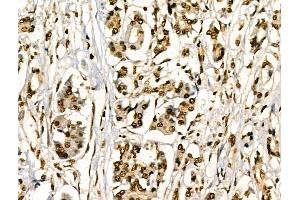 ABIN6256421 and ABIN6267295 at 1/100 staining Human pancreatic cancer and adjacent nomal tissues by IHC-P.