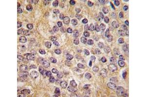 IHC analysis of FFPE human prostate carcinoma tissue stained with UPA antibody (PLAU anticorps  (AA 396-426))