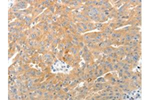 The image on the left is immunohistochemistry of paraffin-embedded Human ovarian cancer tissue using (TEP1 Antibody) at dilution 1/50, on the right is treated with synthetic peptide. (TEP1 anticorps)