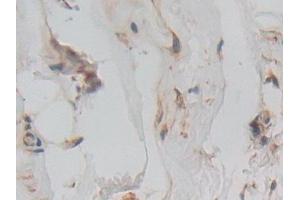 Detection of IFNa/bR1 in Human Breast cancer Tissue using Polyclonal Antibody to Interferon Alpha/Beta Receptor 1 (IFNa/bR1)