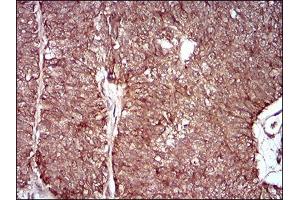 Immunohistochemical analysis of paraffin-embedded ovarian cancer tissues using MMEL1 mouse mAb with DAB staining. (MMEL1 anticorps  (AA 1-107))