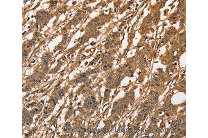 Immunohistochemistry of Human esophagus cancer using CAPZA3 Polyclonal Antibody at dilution of 1:40 (CAPZA3 anticorps)