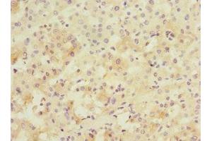 Immunohistochemistry of paraffin-embedded human liver cancer using ABIN7165942 at dilution of 1:100 (PPM1D anticorps  (AA 1-250))