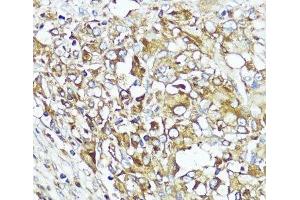 Immunohistochemistry of paraffin-embedded Human liver cancer using MLKL Polyclonal Antibody at dilution of 1:200 (40x lens). (MLKL anticorps)