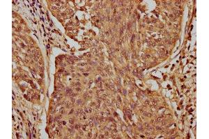 IHC image of ABIN7176570 diluted at 1:100 and staining in paraffin-embedded human cervical cancer performed on a Leica BondTM system. (CASZ1 anticorps  (AA 127-266))