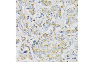 Immunohistochemistry of paraffin-embedded human breast cancer using J antibody (ABIN1678787, ABIN3018048, ABIN3018049 and ABIN6220343) at dilution of 1:100 (40x lens). (ATP5J anticorps  (AA 1-108))