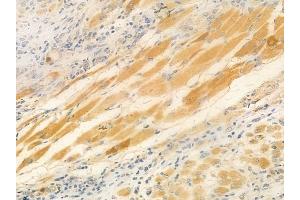 ABIN6259382 and ABIN6276146 at 1/100 staining human tongue carcinoma by IHC-P.