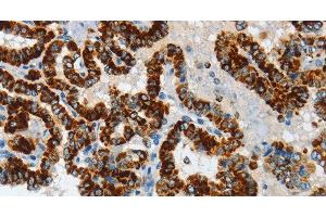 Immunohistochemistry of paraffin-embedded Human thyroid cancer tissue using ASB4 Polyclonal Antibody at dilution 1:40