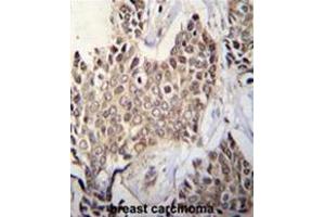 ZBTB42 Antibody (N-term) immunohistochemistry analysis in formalin fixed and paraffin embedded human breast tissue followed by peroxidase conjugation of the secondary antibody and DAB staining. (ZBTB42 anticorps  (N-Term))