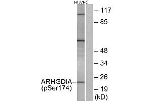 Immunohistochemistry analysis of paraffin-embedded human cervix carcinoma tissue using ARHGDIA (Phospho-Ser174) antibody. (ARHGDIA anticorps  (pSer174))