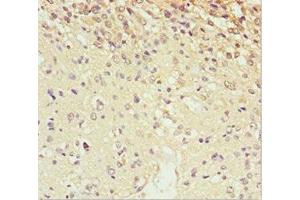 Immunohistochemistry of paraffin-embedded human glioma using ABIN7168663 at dilution of 1:100