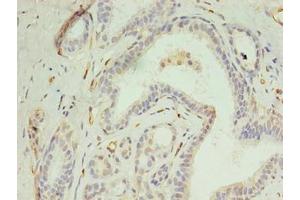 Immunohistochemistry of paraffin-embedded human breast cancer using ABIN7150021 at dilution of 1:100 (DIP2A anticorps  (AA 1-300))