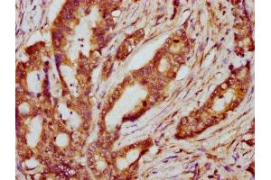 IHC image of ABIN7169246 diluted at 1:600 and staining in paraffin-embedded human colon cancer performed on a Leica BondTM system.