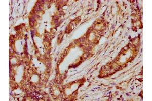 IHC image of ABIN7169246 diluted at 1:600 and staining in paraffin-embedded human colon cancer performed on a Leica BondTM system. (PPP2R2B anticorps  (Regulatory Subunit B))