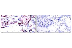 Immunohistochemical analysis of paraffin- embedded human breast carcinoma tissue using ATF-2 (Ab-71or 53) antibody (E021031). (ATF2 anticorps)