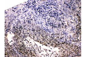 HDGF was detected in paraffin-embedded sections of human lung cancer tissues using rabbit anti- HDGF Antigen Affinity purified polyclonal antibody (Catalog # ) at 1 µg/mL. (HDGF anticorps  (C-Term))