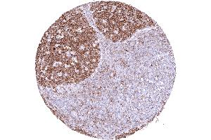 Tonsil with intensive cytoplasmic MX1 staining of lymphocytic cells especially in germinal centres