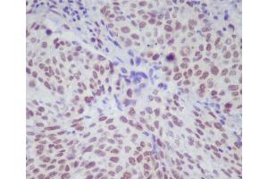 Immunohistochemical analysis of paraffin-embedded human lung cancer, using Phospho-STAT1 (S727) Antibody.