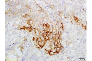 Formalin-fixed and paraffin embedded human esophageal carcinoma labeled with Rabbit Anti-CK7 Polyclonal Antibody, Unconjugated  at 1:200 followed by conjugation to the secondary antibody and DAB staining (Cytokeratin 7 anticorps  (AA 251-350))