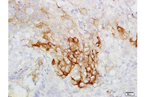 Formalin-fixed and paraffin embedded human esophageal carcinoma labeled with Rabbit Anti-CK7 Polyclonal Antibody, Unconjugated  at 1:200 followed by conjugation to the secondary antibody and DAB staining (Cytokeratin 7 anticorps  (AA 251-350))