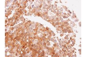 IHC-P Image Immunohistochemical analysis of paraffin-embedded PLC xenograft, using NQO2, antibody at 1:100 dilution.