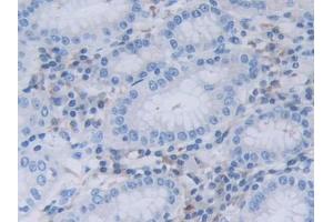 DAB staining on IHC-P; Samples: Human Stomach cancer Tissue (RNASEL anticorps  (AA 358-583))