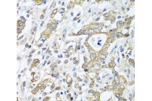 Immunohistochemistry of paraffin-embedded Human gastric cancer using TICAM1 Polyclonal Antibody at dilution of 1:100 (40x lens). (TICAM1 anticorps)