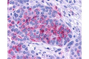 Anti-ADCYAP1R1 / PAC1 Receptor antibody IHC of human Ovary, Carcinoma. (ADCYAP1R1 anticorps  (C-Term))
