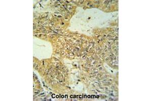 CLDN23 Antibody (C-term) IHC analysis in formalin fixed and paraffin embedded colon carcinoma followed by peroxidase conjugation of the secondary antibody and DAB staining. (Claudin 23 anticorps  (C-Term))