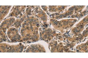 Immunohistochemistry of paraffin-embedded Human breast cancer tissue using CTNNBIP1 Polyclonal Antibody at dilution 1:30 (CTNNBIP1 anticorps)