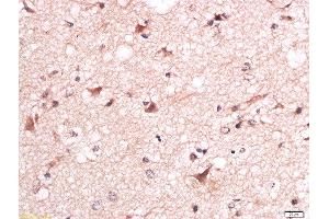 Formalin-fixed and paraffin embedded human brain glioma labeled with Anti-Torc1 (Ser151) Polyclonal Antibody, Unconjugated  at 1:200 followed by conjugation to the secondary antibody and DAB staining. (CRTC1 anticorps  (pSer151))