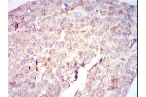 Immunohistochemical analysis of paraffin-embedded liver cancer tissues using RAF1 mouse mAb with DAB staining. (RAF1 anticorps)