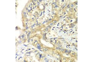 Immunohistochemistry of paraffin-embedded human liver cancer using TIMM17A antibody at dilution of 1:100 (x40 lens). (TIMM17A anticorps)