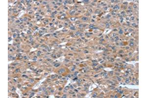The image on the left is immunohistochemistry of paraffin-embedded Human liver cancer tissue using ABIN7130819(RASAL1 Antibody) at dilution 1/20, on the right is treated with fusion protein. (RASAL1 anticorps)