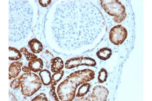 Formalin-fixed, paraffin-embedded human Renal Cell Carcinoma stained with CDH16-Monospecific Mouse Monoclonal Antibody (CDH16/2125).
