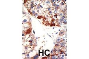 Formalin-fixed and paraffin-embedded human cancer tissue reacted with the primary antibody, which was peroxidase-conjugated to the secondary antibody, followed by DAB staining.