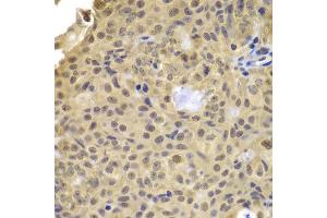 Immunohistochemistry of paraffin-embedded human well-differentiated squamous skin carcinoma using CCNA2 antibody at dilution of 1:100 (x400 lens). (Cyclin A anticorps)